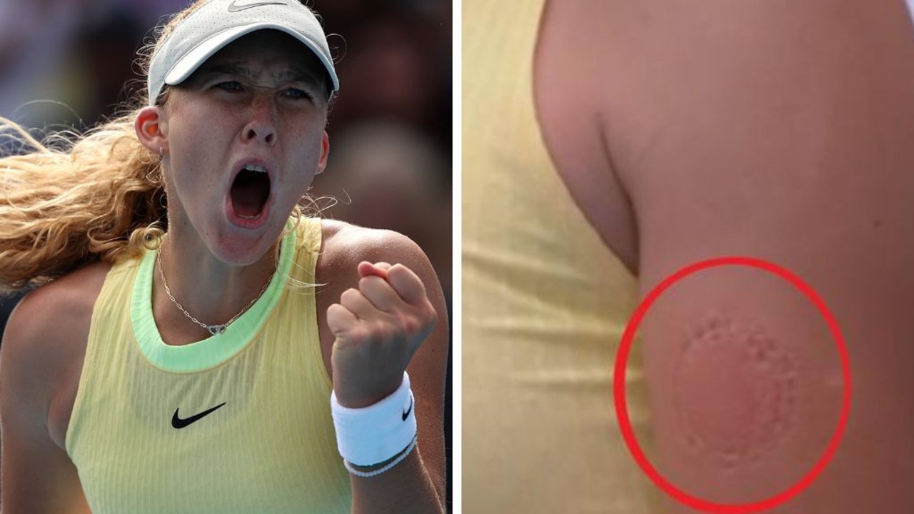 Mirra Andreeva’s third round match was so intense she left a bite mark on her arm. Pictures: Getty Images and Fox Sports