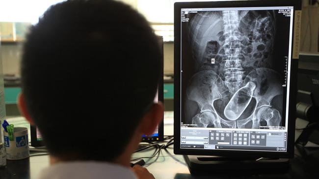 Shocking X Ray Shows Man With Glass Bottle Stuck Inside Him