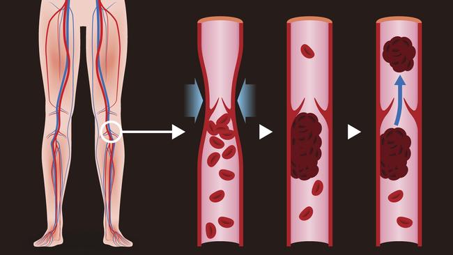 A diagram of deep vein thrombosis.