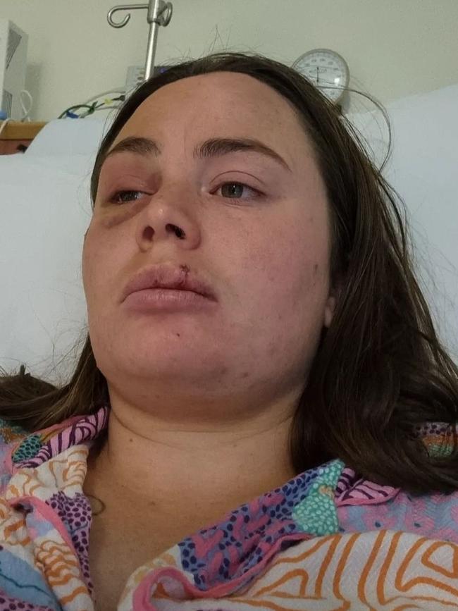 She has been left with post-concussion syndrome and PTSD after the attack on her. Picture: Supplied