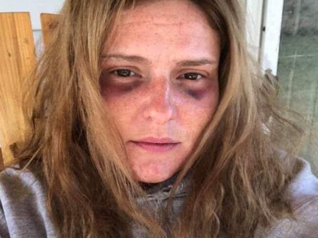 Mary Haley vanished after sending two selfies, including one seen above, with black eyes to the administrator of Facebook domestic violence support group. Picture: Facebook