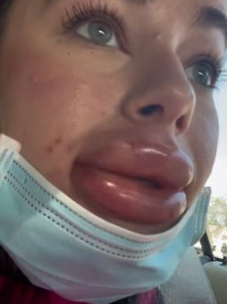 Botched cosmetic procedures: Jessica Burko's lip filler injection explodes  | news.com.au — Australia's leading news site