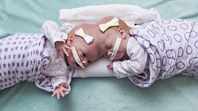 Conjoined Twins Separated Successfully At 10 Months Old Daily Telegraph