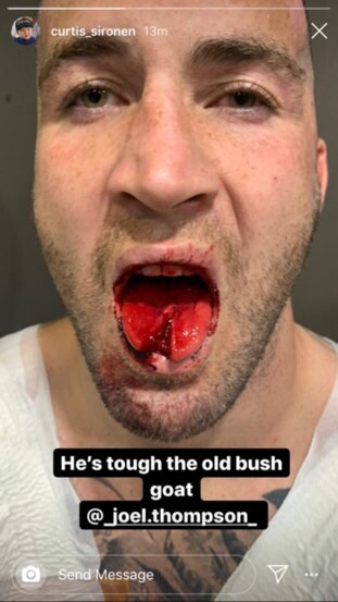 Joel Thompson’s tongue after the Manly v Newcastle game. Source: Instagram (@curtis_sironen)