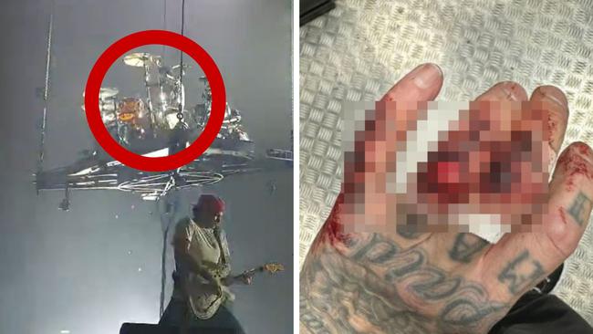 Travis Barker sustained a gruesome hand injurt onstage during Blink-182's concert in Manchester, UK.