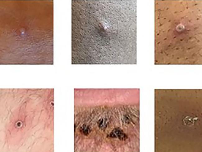 A handout picture made available by the UK Health Security Agency (UKHSA) on June 22, 2022 shows a collage of monkeypox rash lesions at an undisclosed date and location. - Monkeypox may soon have a new name after scientists called for a change to dispel stereotypes of Africa being seen as a crucible of disease. The World Health Organization announced last week that it is "working with partners and experts from around the world on changing the name of monkeypox virus, its clades and the disease it causes." (Photo by Handout / UK Health Security Agency / AFP) / RESTRICTED TO EDITORIAL USE - MANDATORY CREDIT "AFP PHOTO /  UK HEALTH SECURITY AGENCY" - NO MARKETING - NO ADVERTISING CAMPAIGNS - DISTRIBUTED AS A SERVICE TO CLIENTS