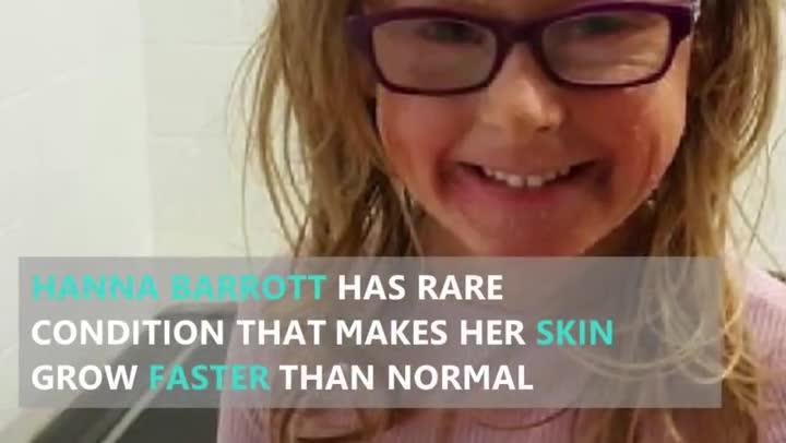 Hanna Barrott has rare condition that makes her skin grow faster than normal