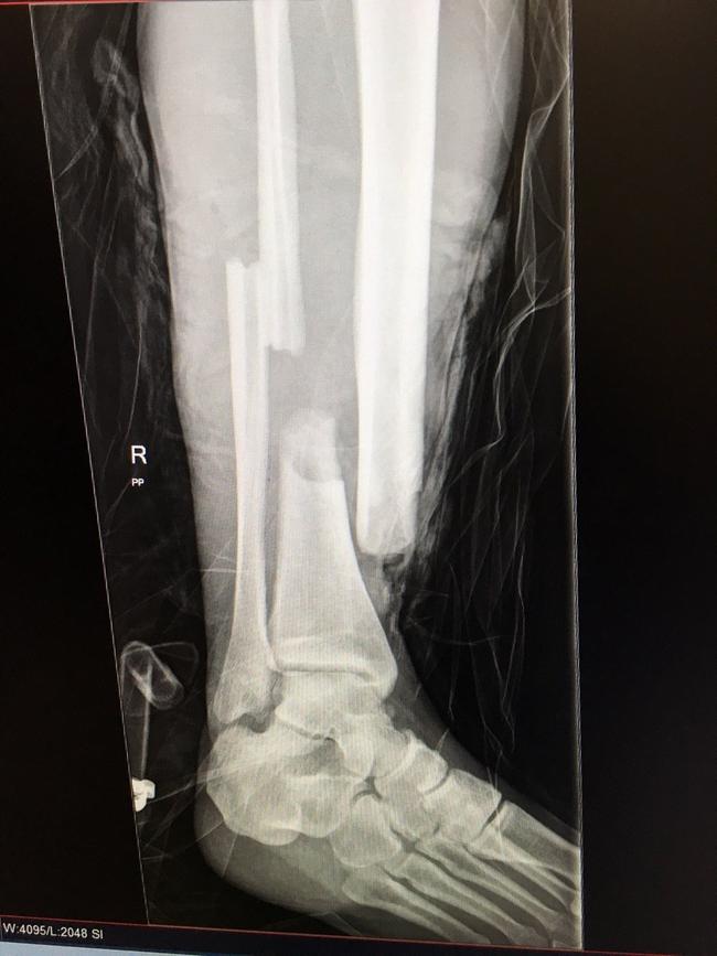 An x-ray of Tim Lawson's fractured leg after the tackle.