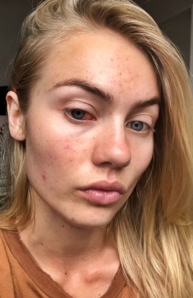 She shared a bunch of selfies showing the condition of her skin, something she has been battling with for years.