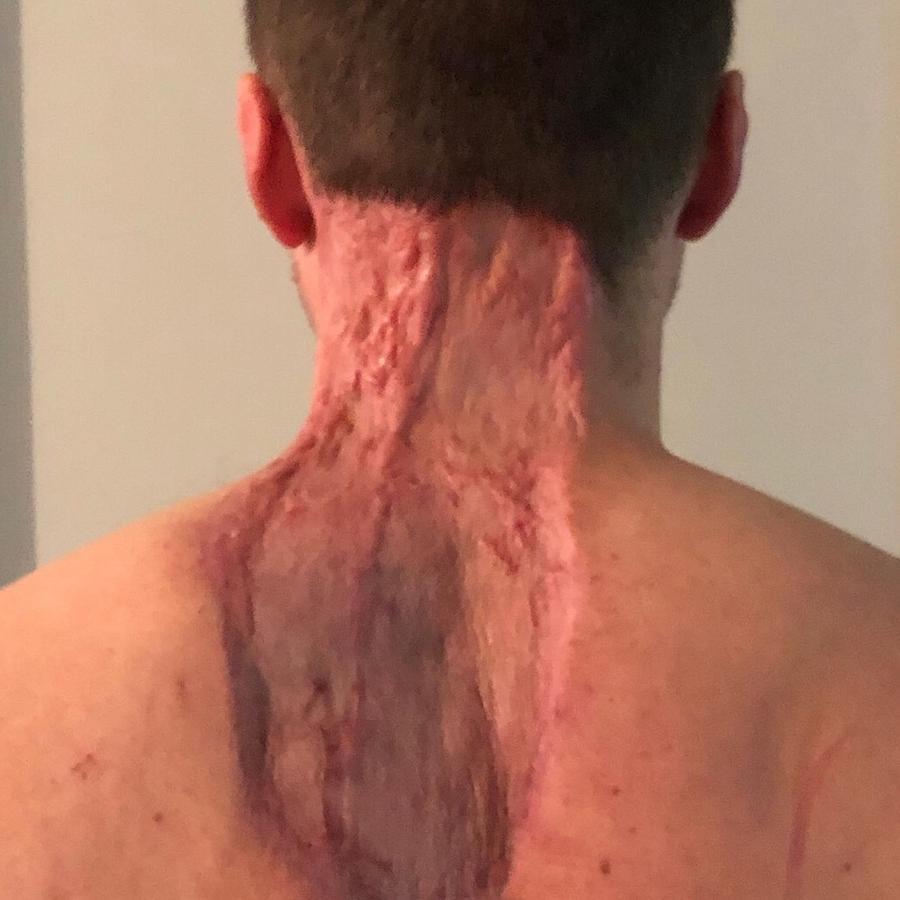 A final surgery in May this year involved a large chunk of skin being removed from the back of both Mr Glossop’s legs to cover the patch on the back of his neck. Picture: Facebook / A Little Beauty