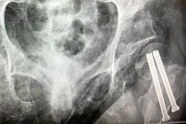 An x-ray of Eden's hip after surgery. Picture: 7.30 ABC