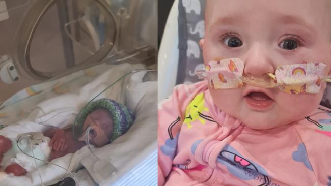 Miracle babies Skylar this week celebrated her first Birthday. Picture: Supplied