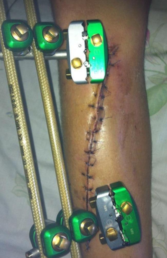 Grant’s leg after an all-terrain vehicle rolled onto his leg as a teenager. Picture: Instagram