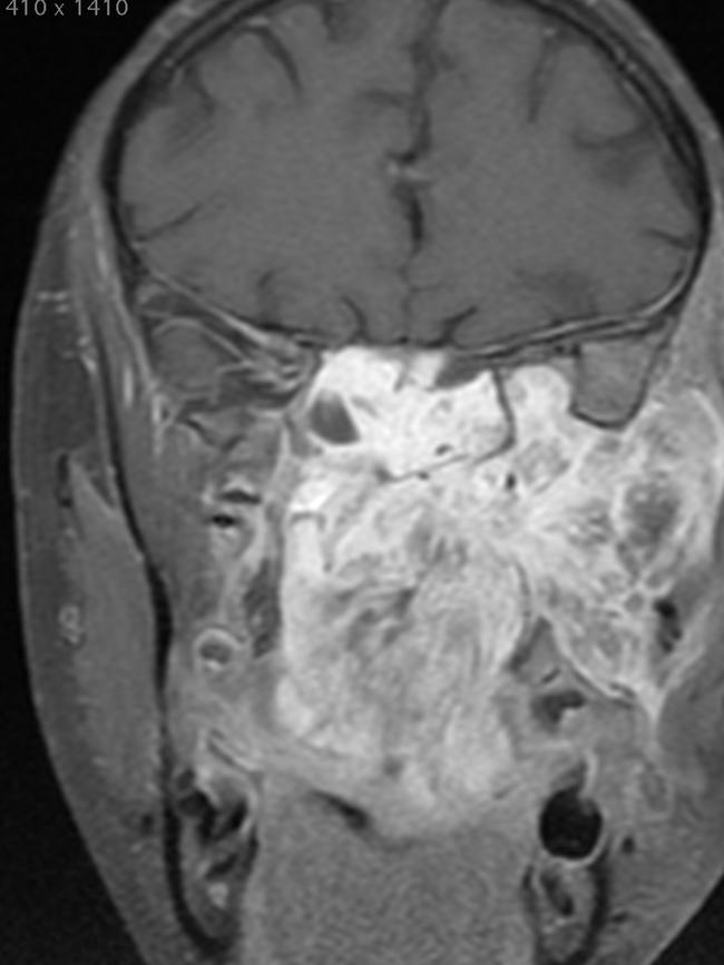 MRI scans of Ronny’s nasal tumour. Picture: Supplied