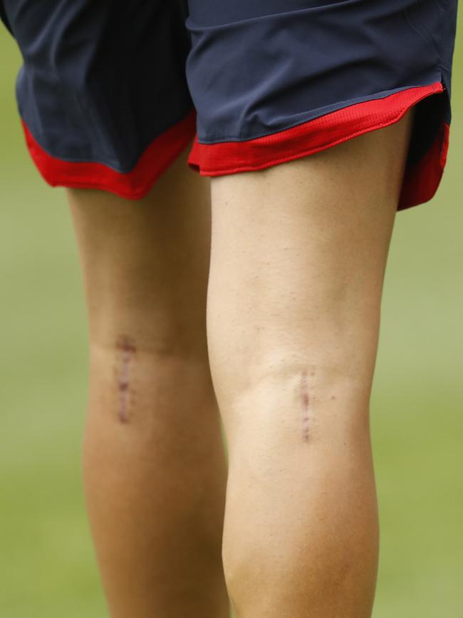 The scars on Bennell’s legs following surgery. Picture: Getty