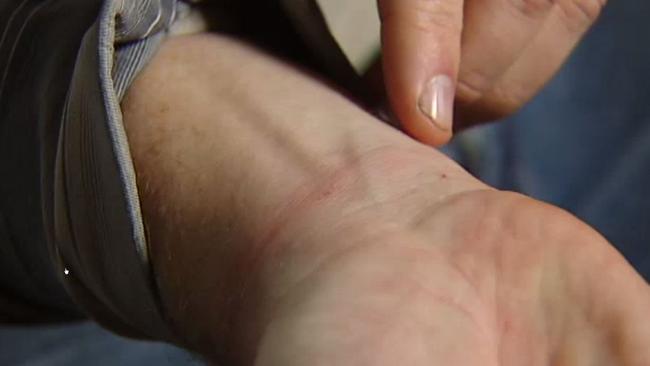 Greg Rolles showing the mark on his wrists from the plastic ties. Picture: ABC