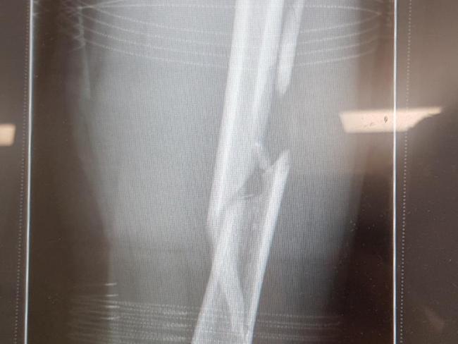 The X-ray of Constable Garland's shattered left femur. Picture: supplied