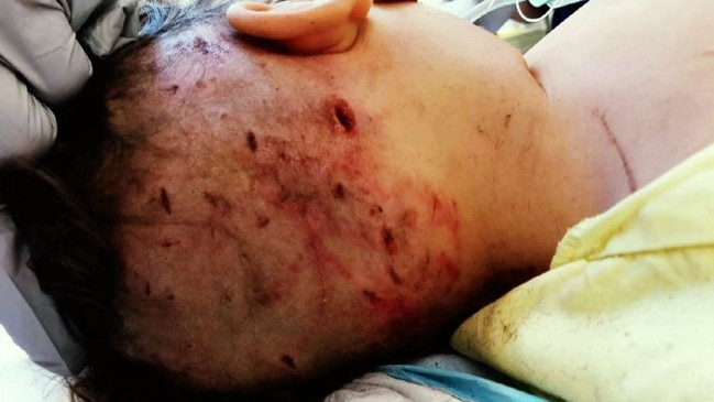 The injuries sustained by Hunter during his ordeal. Picture: Channel 9