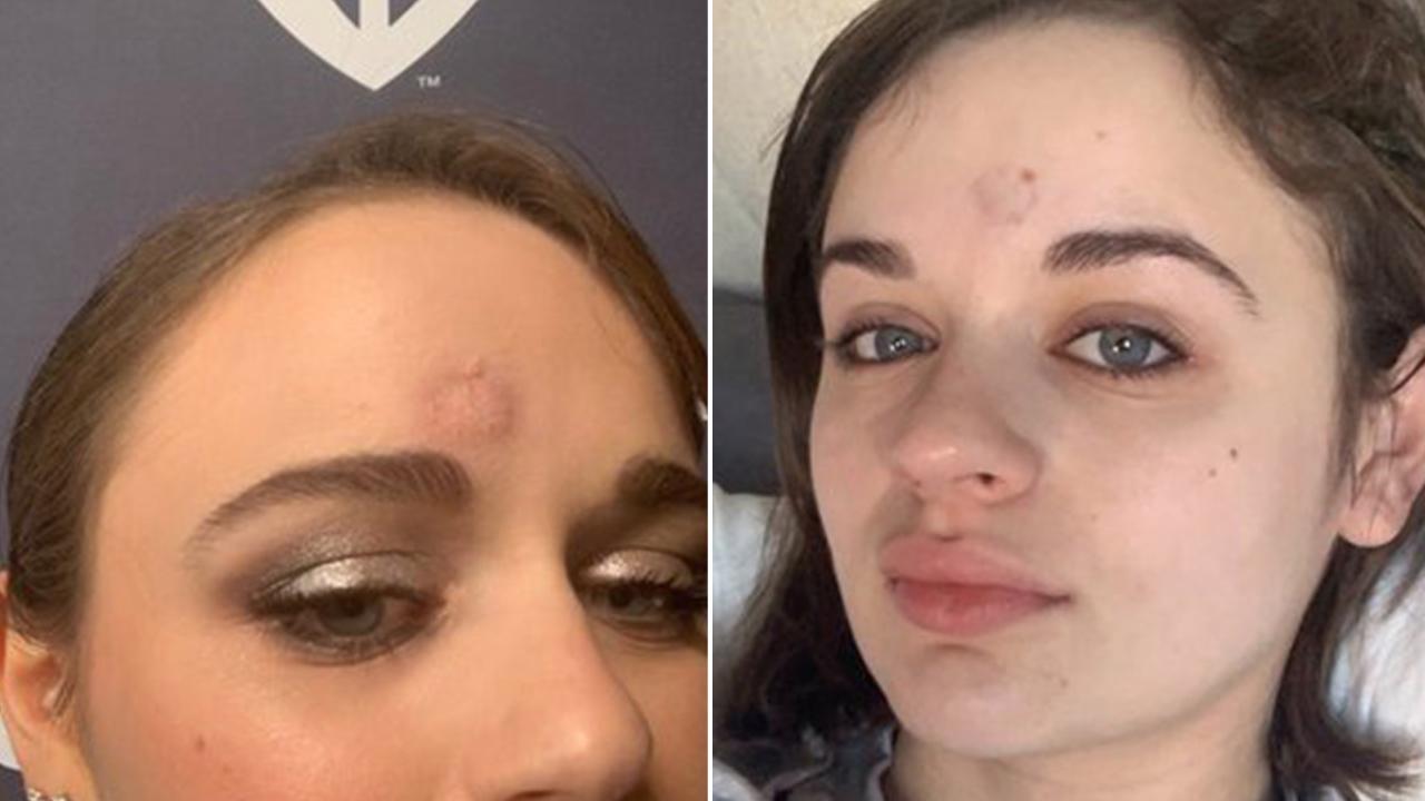 Joey King shows off her bruise from Patricia Arquette's Golden Globe trophy.