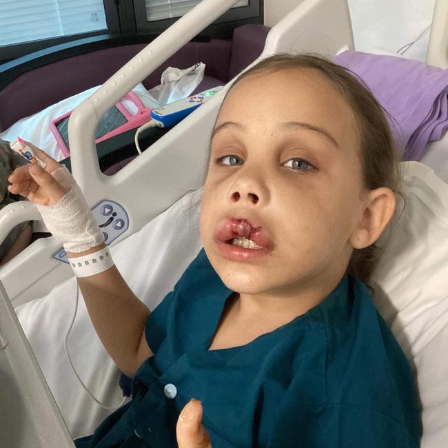 As a result Rylie Jack’s front tooth was forced into her nasal cavity, badly fracturing her top jaw. Picture: Supplied to Daily Mercury