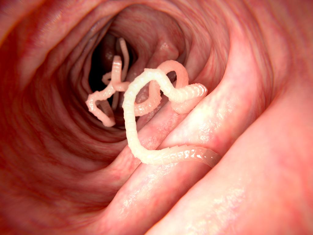 Tapeworms are often found living in a person’s intestines and occur when a person eats undercooked pork or comes into contact with tapeworm eggs. Picture: iStock