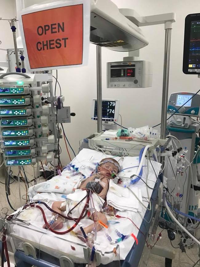 Mason Haevecker following heart surgery in the Lady Cilento (now Queensland Children's Hospital) in Brisbane in 2017. Picture: Facebook.