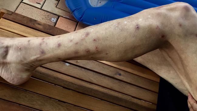 The 76 year old Helensvale woman’s leg after being bitten by mosquito bites and contracting Ross River virus.