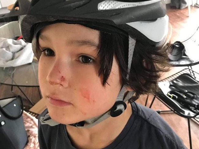 Brodie recieved facial cuts from a bird attack while cycling in Bicentennial Park.