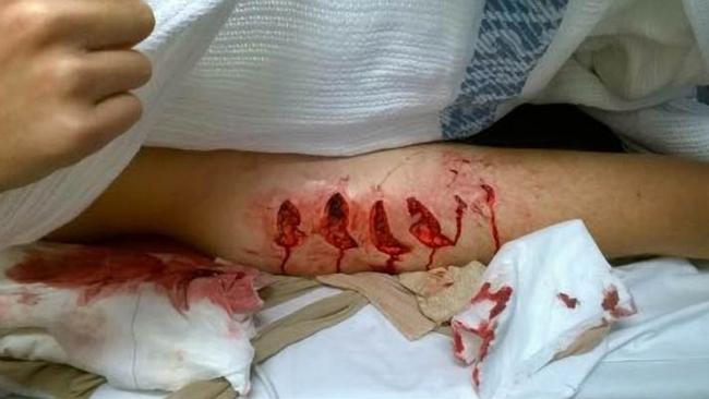 The horrific wound to the leg of Ballina shark attack victim Cooper Allen ./ Supplied