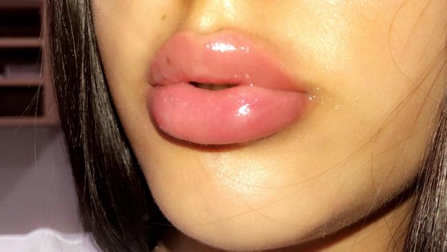 Women who want the fuller cheek and lip look are being told to look for a qualified doctor to do the procedure. Picture: Supplied