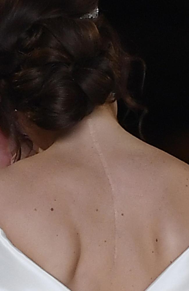 Princess Eugenie’s surgery scar, she said she didn’t want to cover it up. Picture: Getty