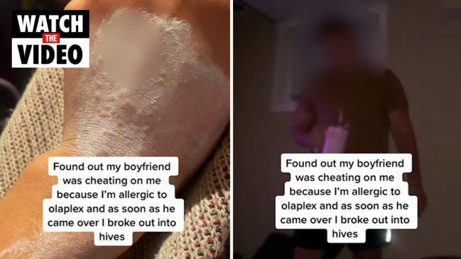 ‘I realised my man cheated when I broke out in hives’