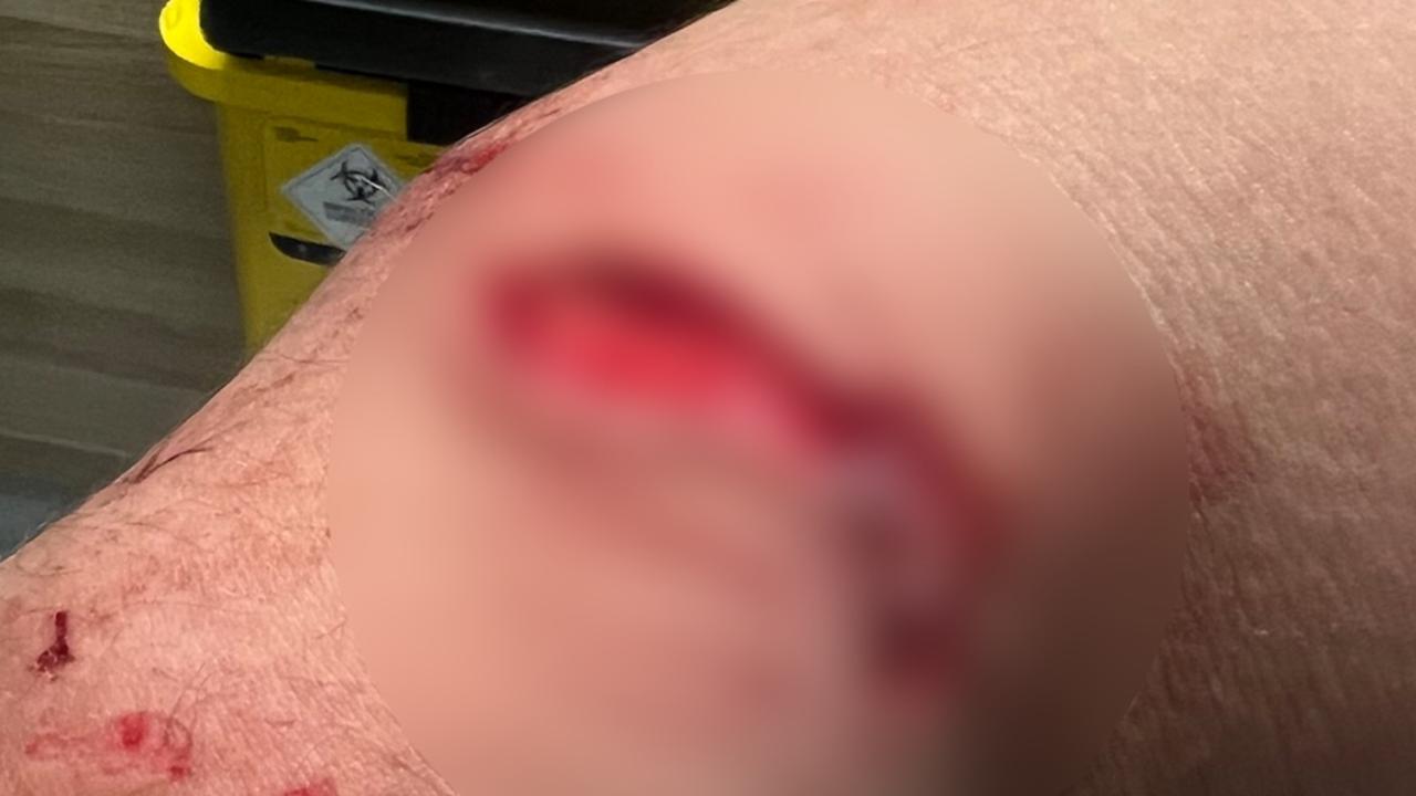 Graphic images of Tim Tszyu's dog bite injury