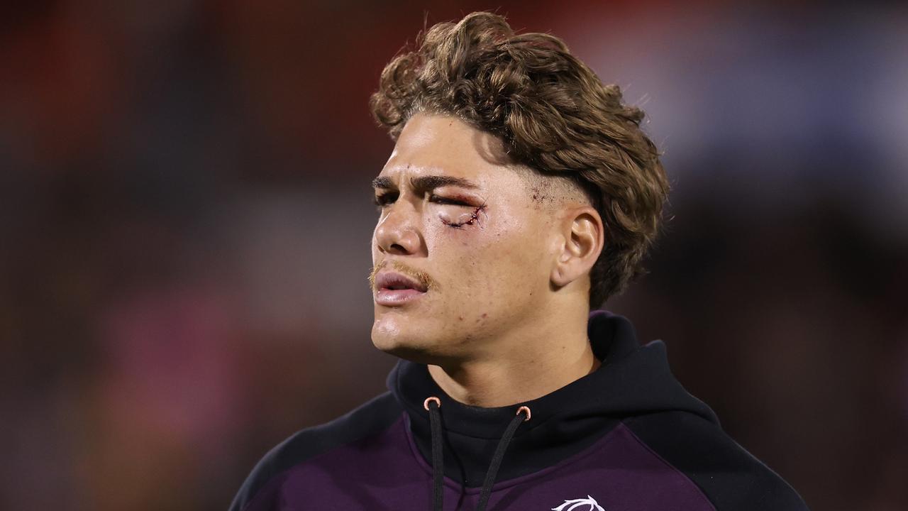 Walsh was left sporting a nasty battle wound. (Photo by Jason McCawley/Getty Images)