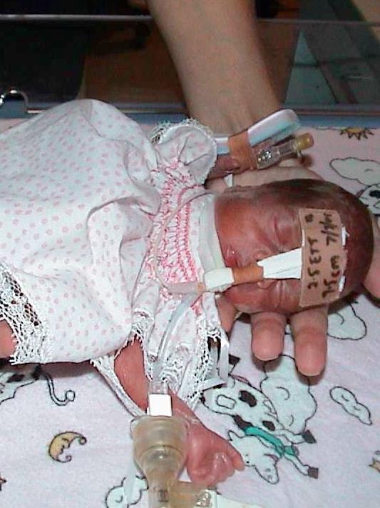 Grace survived three major infections and she had a small bleed in her brain. Picture: Supplied