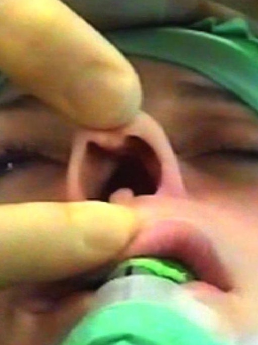 During one of her many surgeries.