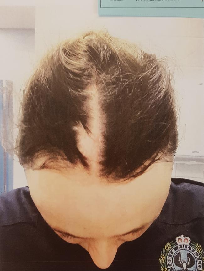 Injuries sustained by SA Police Constable Anthea Beck, allegedly inflicted by Raina Jane Cruise. Picture: District Court registry