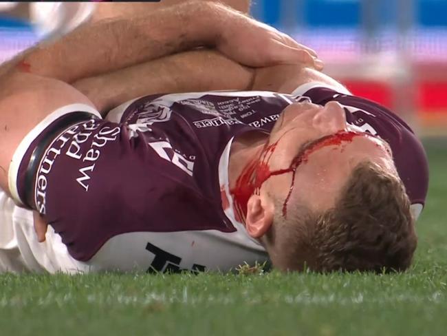 This is not what anyone wants to see. Photo: Fox Sports