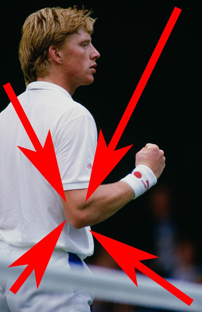 Boris Becker back in 1987. NOTE THE ORDINARY, LUMPLESS ELBOW.