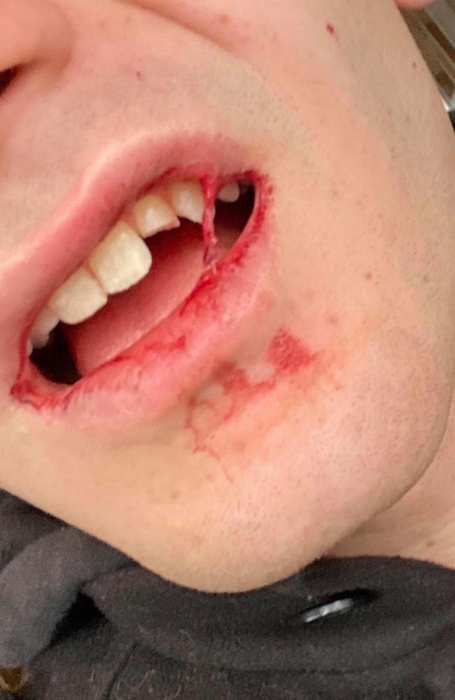 The 24-year-old victim said he sustained injuries including a split lip, bruising and a cracked tooth when he was punched by a stranger at Casey Central.