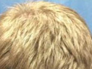 Eight months ... The 25-year-old man now sports a thick mane of blond locks. Picture: Yale University