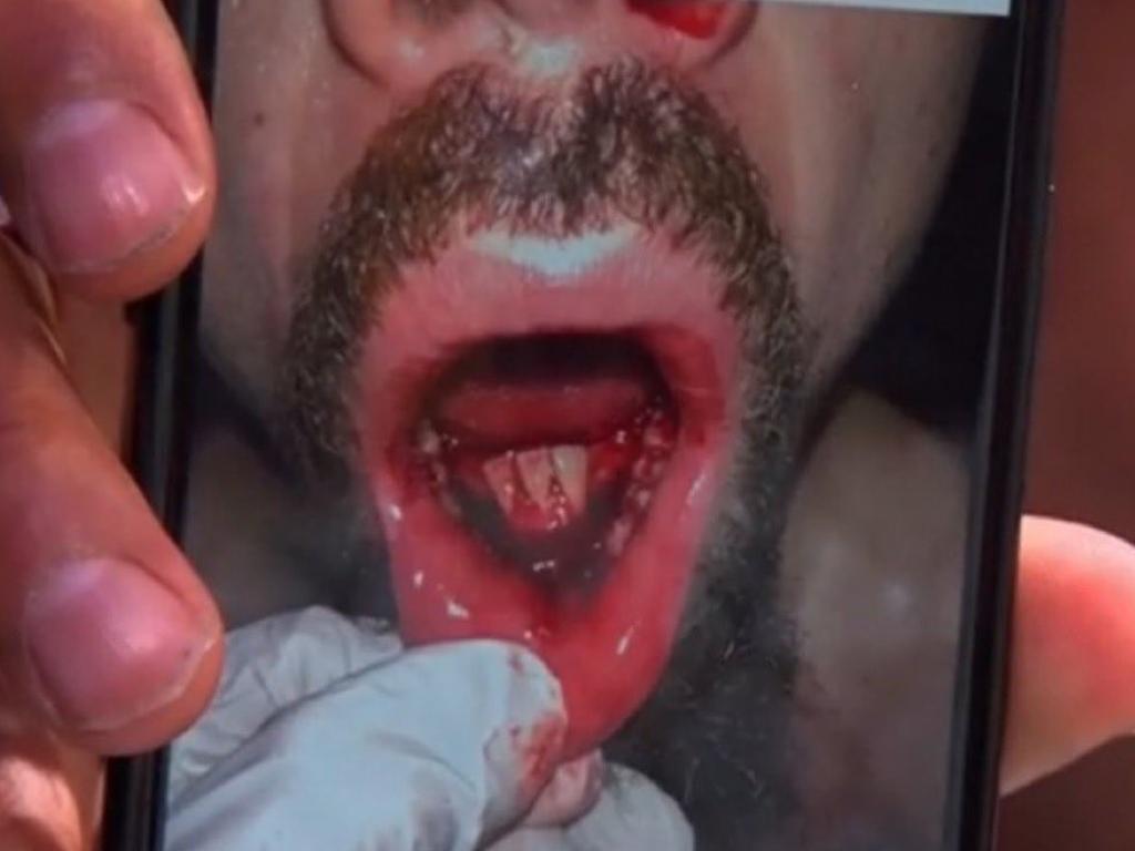 Robert Whittaker's mouth after his fight against Khamzat Chimaev. Picture: Supplied