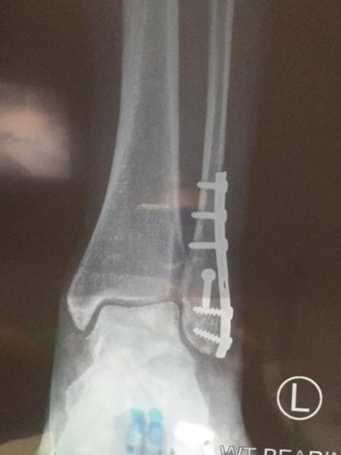 The injury required screws to be inserted.