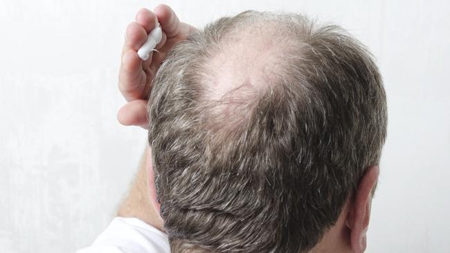 Topical creams have been developed to regenerate hair. Picture: Getty Images