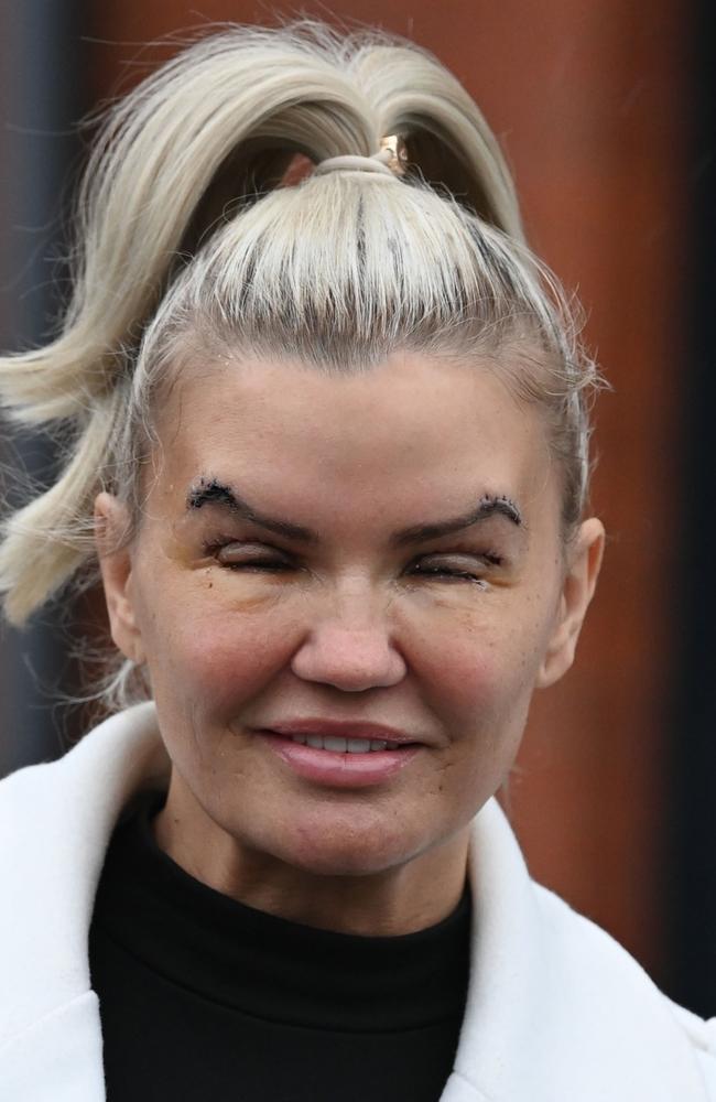 Jaw-dropping Photos Of Atomic Kitten Star Kerry Katona Post-eyelift ...