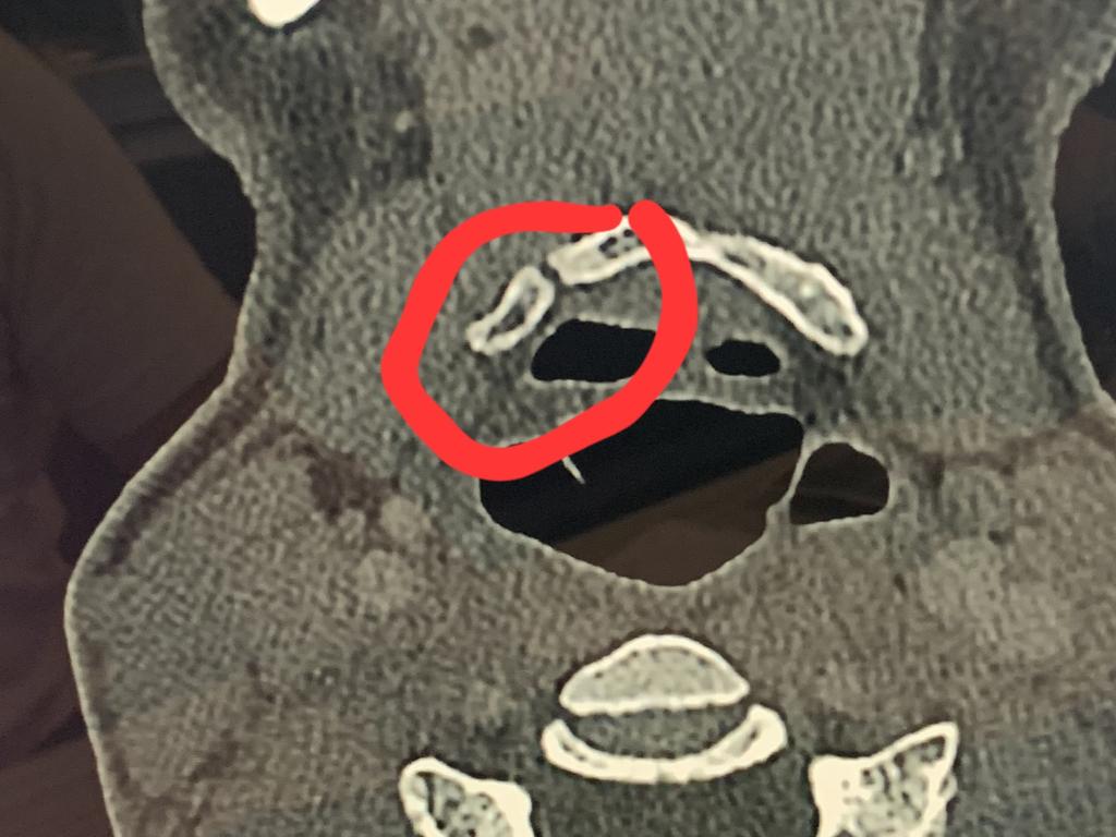 A medical scan of the broken hyoid bone in Bree's neck, sustained during a violent strangulation.