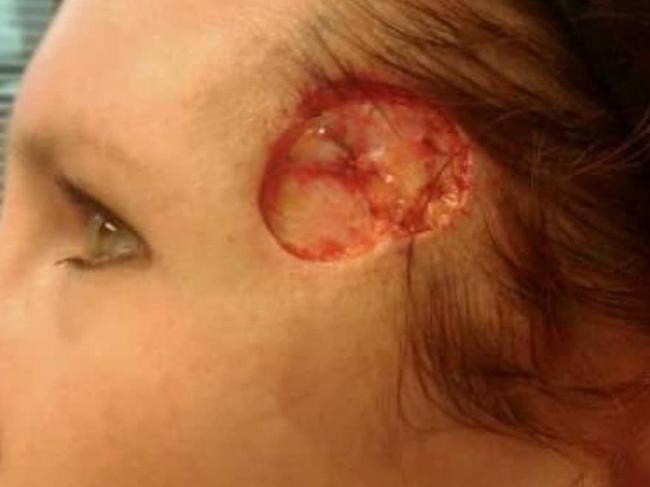 The hole that was left in Carrie's face after the surgery to remove her cancer. Picture: Media Drum World/Australscope