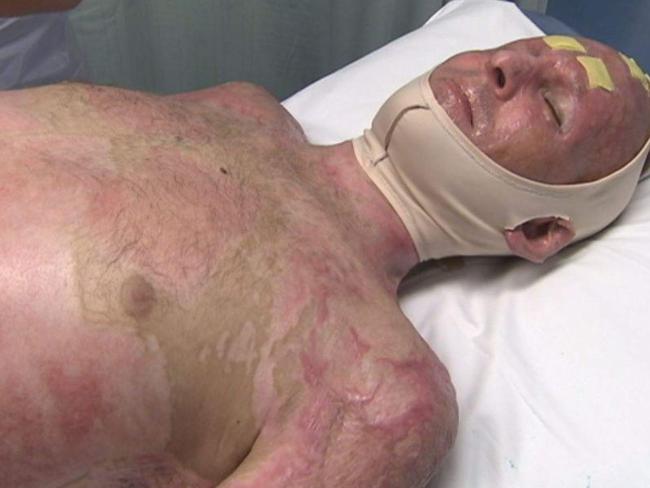 The long and painful recovery from serious burns to 40 per cent of his body. Picture: ABC