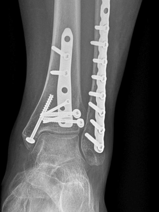 The screws and plates required to fix Renee’s foot.