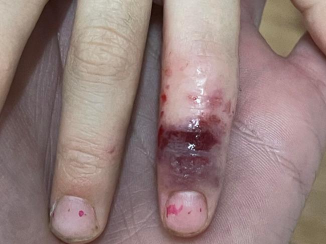 ‘It’s heartbreaking’: Mother’s advice for debilitating skin condition